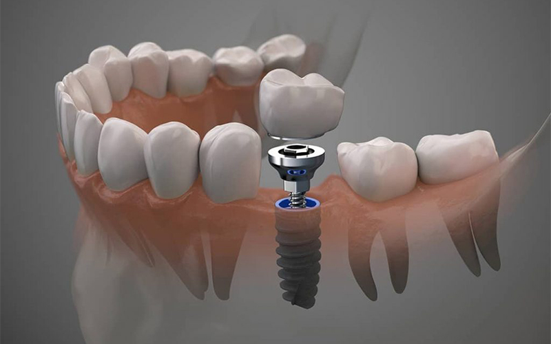 Dental Implant